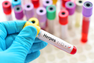 Herpes (HSV) 1 & 2 Test